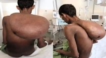 Ethiopia-farmer-giant-lipoma-surgery-recovery