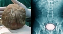 China-farmer-bladder-stone-surgery-shock