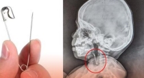 Doctors remove safety pin from 2 years old boy
