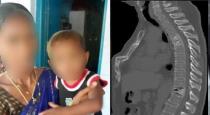 Telangana doctors find 11 needles in three-year-old’s body