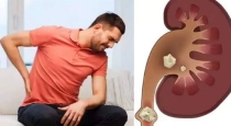 How to recover kidney stones 
