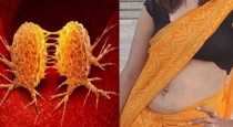 Saree cancer or Squamous Cell Carcinoma in india 