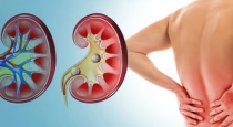 How to recover kidney stone 