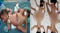 Indonesia Twin Born by Conjoined 4 Arms 3 Leges Ischiopagus Tripus Phenomenon 