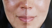 What causes pigmentation that affects facial beauty..  What is the solution..