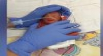 Weight 350 grams...smallest baby in the world...doctors in surprise...