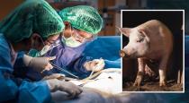 Pig kidney to human viral news