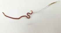 doctors-found-a-worm-in-woman-tonsil-after-she-ate-live
